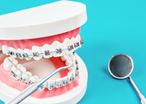 what-are-dental-braces.jpeg